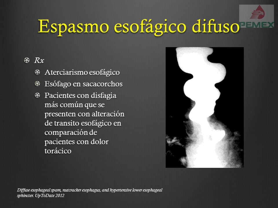 espasmo esofagico difuso
